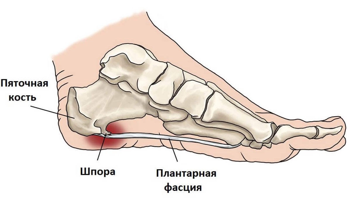 Симптомы и лечение плантарного фасциита (подошвенного)